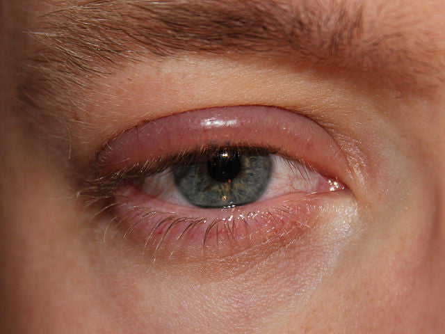 What is Blepharitis?